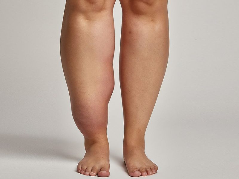 Tratamento para Lipedema